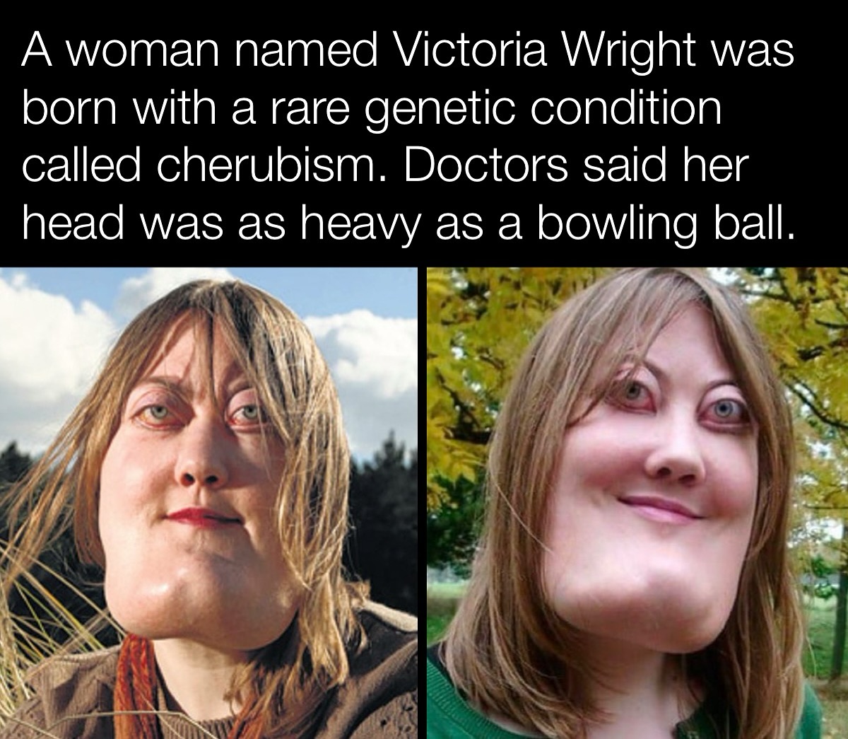 Ancient - Victoria Wright was born with a rare genetic condition known ...