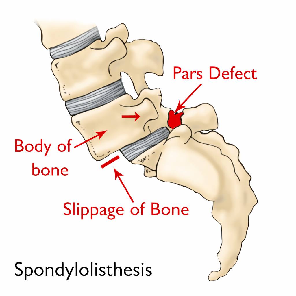Knowledge3dart - Spondylolisthesis Spondylolisthesis is... | Facebook