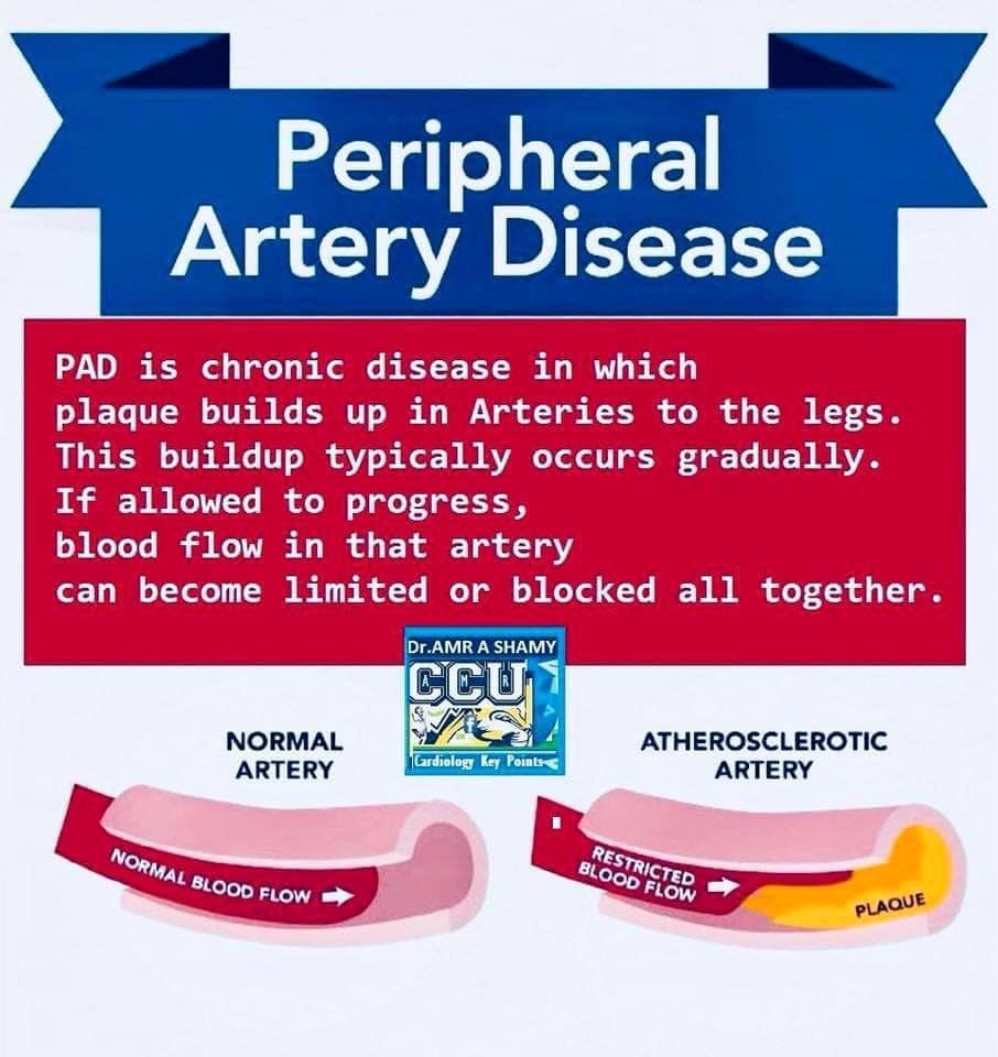 CCU - 🎗Peripheral arterial disease (PAD) of Lower...
