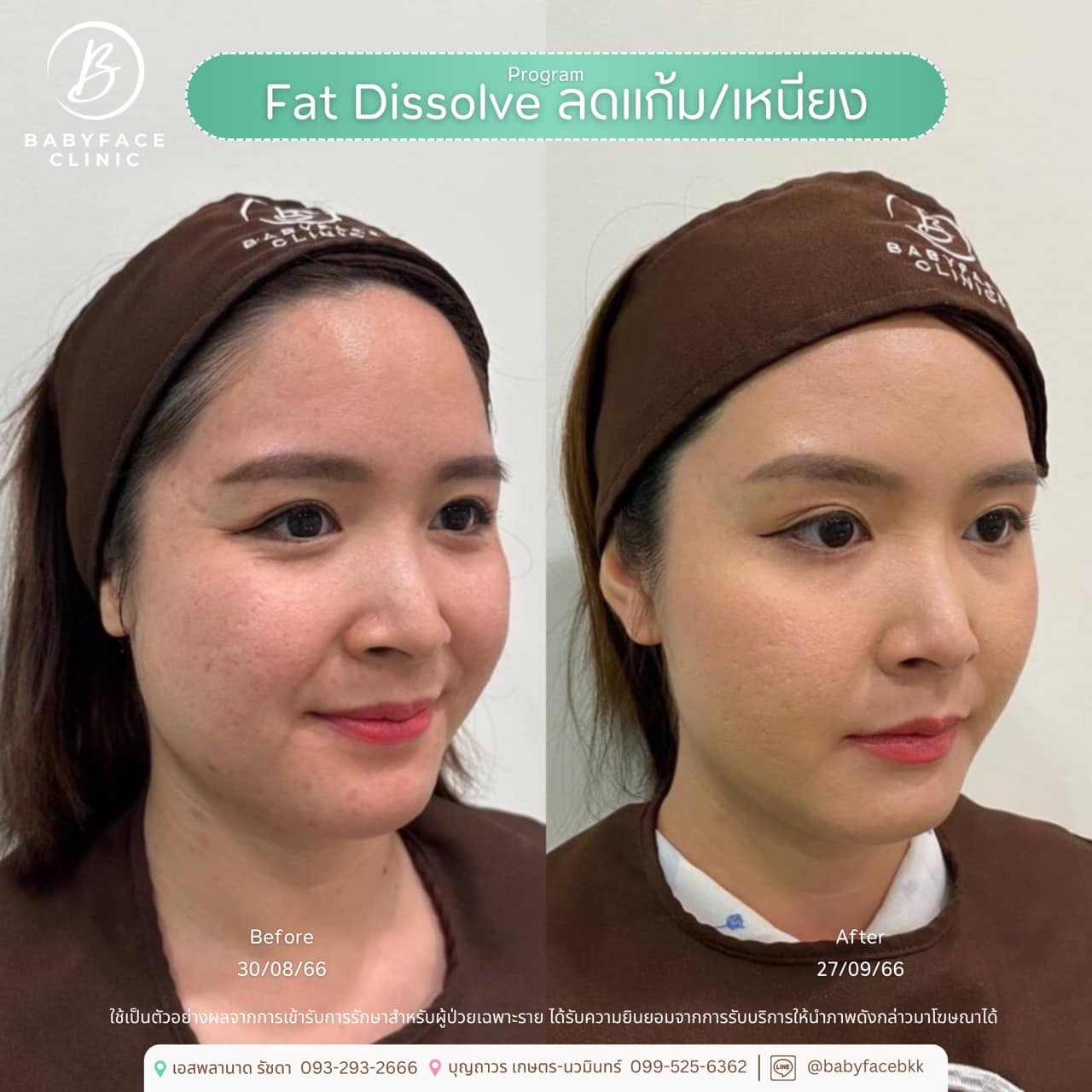 Babyface - #รีวิวคนไข้เบบี้เฟซ Program Fat Dissolve ลดแก้ม/เหนียง หน้า ...