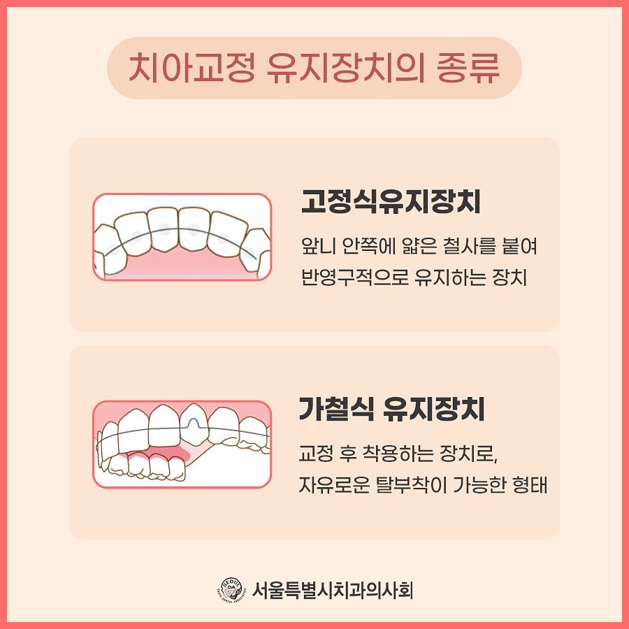 서울시치과의사회 - 치아교정 끝나도 끝난게 아닌 이유는 바로 유지장치 때문인데요! 유지장치의 종류부터,...
