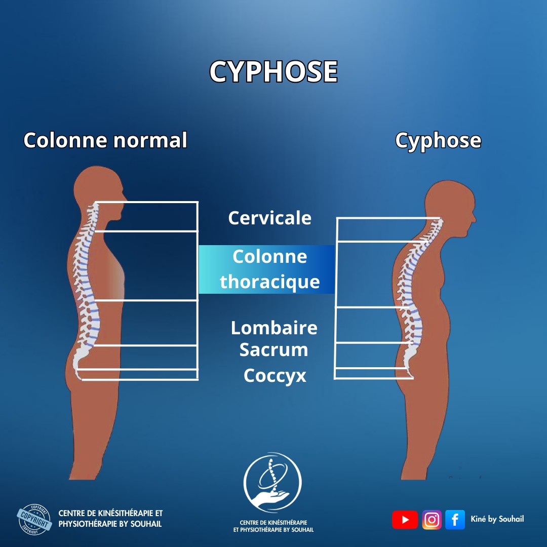 centre-la-cyphose-est-une-courbure-excessive-de-la-colonne-vert-brale