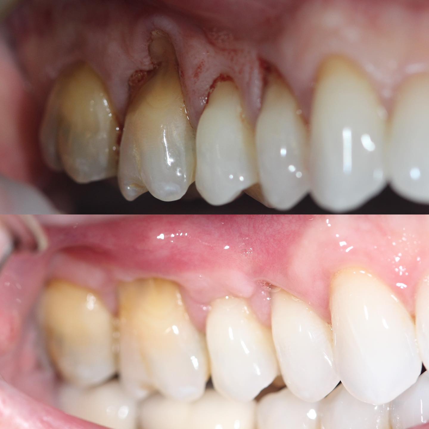 denver-did-you-know-gum-whitening-bleaching-is-a-very-safe-and