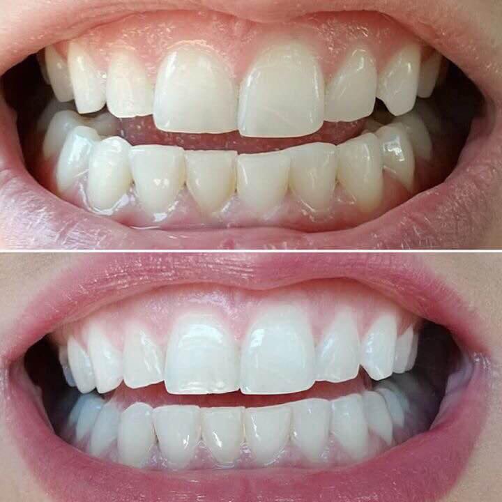Toothpaste Duo - Here are some amazing before and after... | Facebook