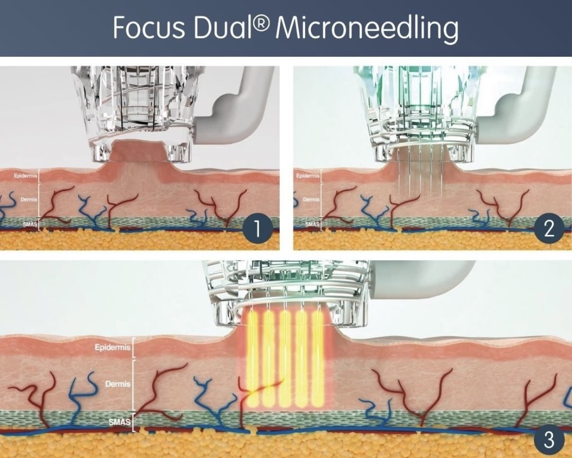 Our Radiofrequency... - Defyne Aesthetics Skin & Laser Clinic | Facebook