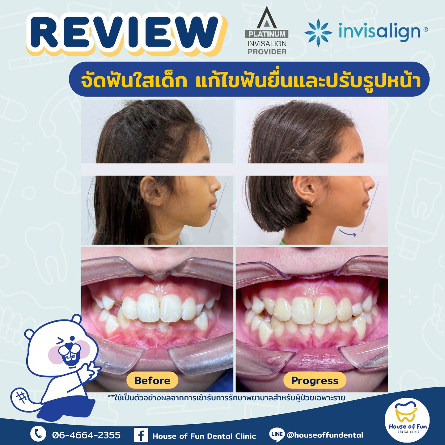 House - Review จัดฟันใสเด็ก Invisalign First แก้ไขฟันยื่น และปรับรูป ...