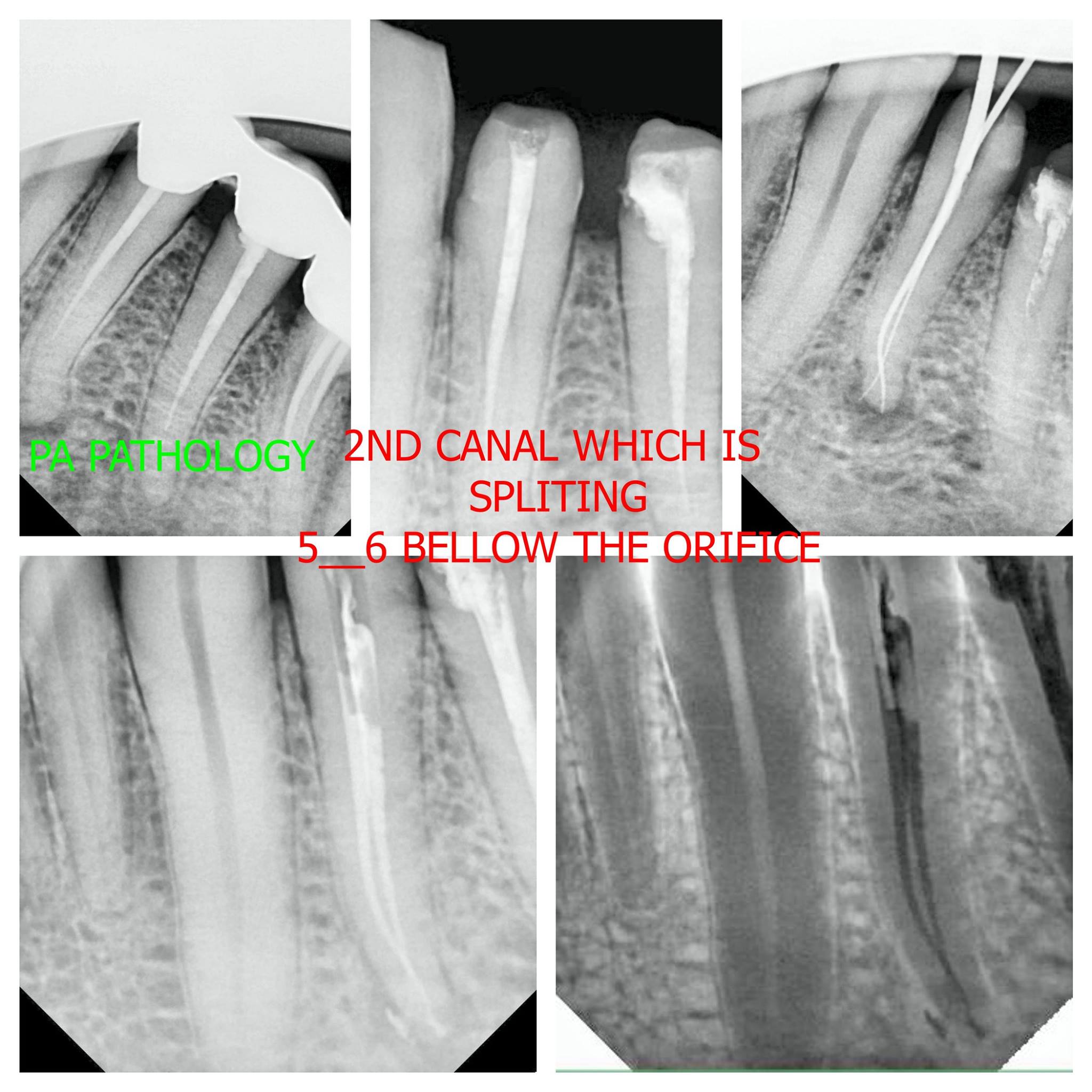 re rct of lower 4 having 2... - Smiles & Braces Dental Clinic