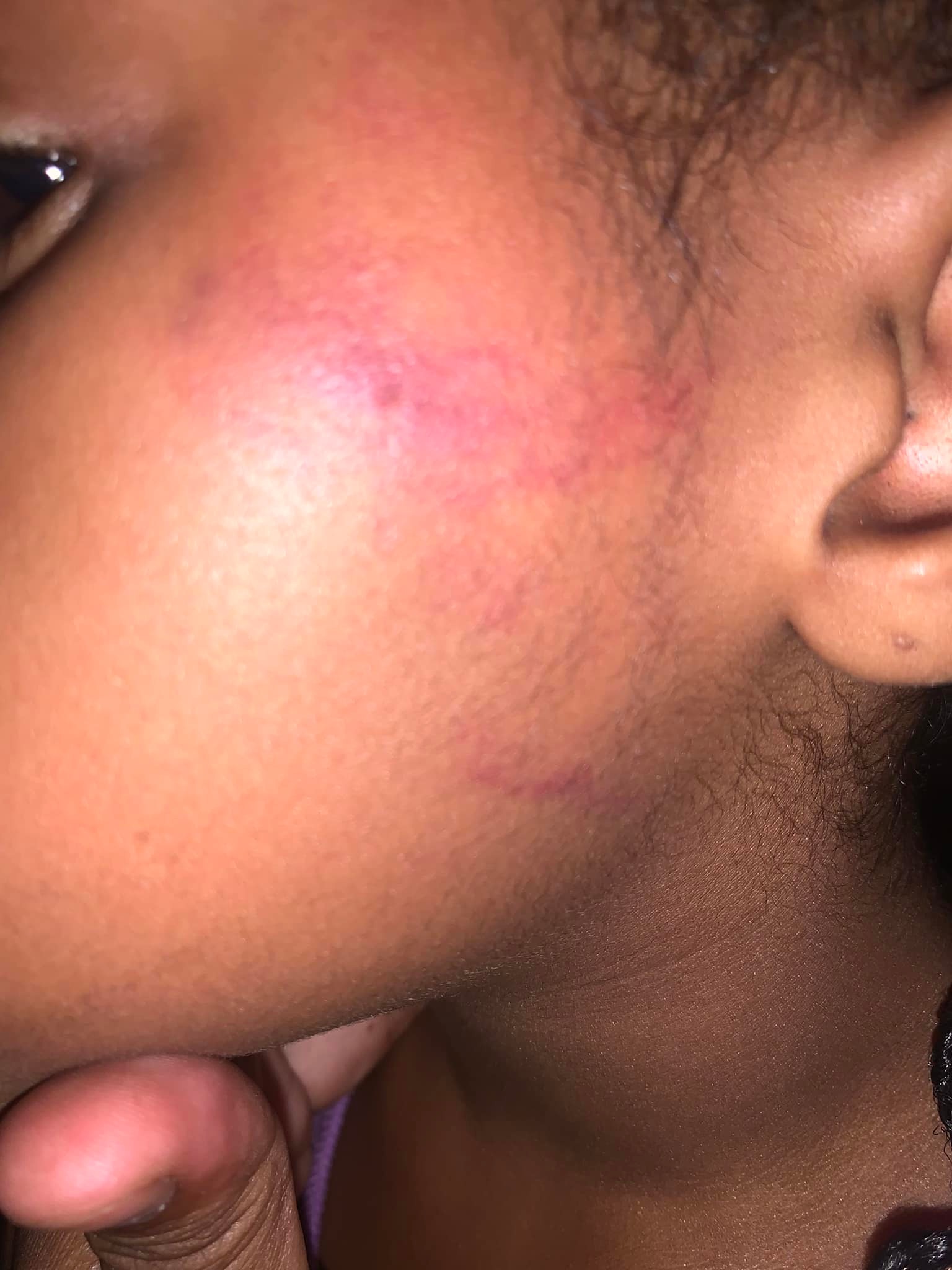 What is the proper way to report a suspicious bruise found on a