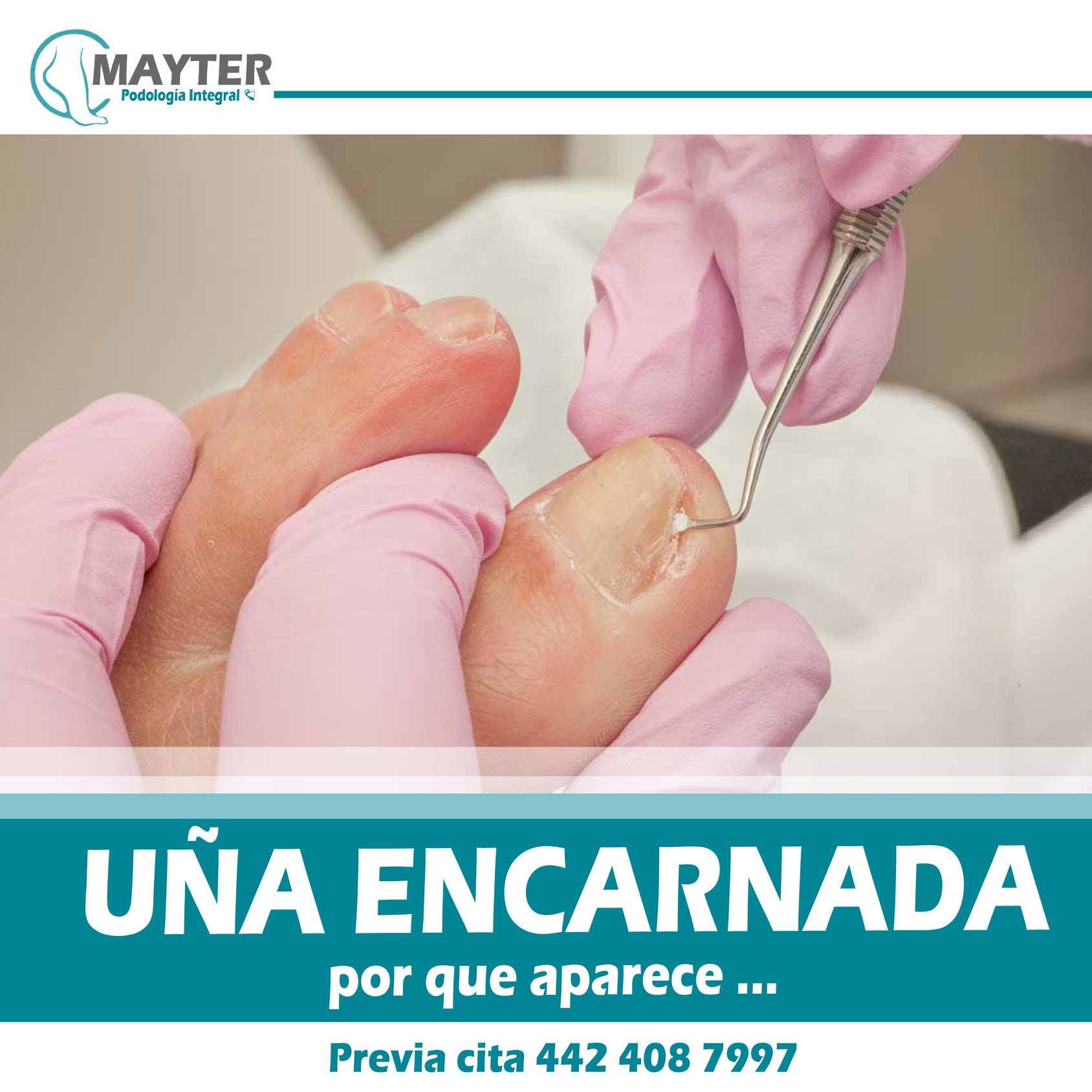 UÑA... - Podologia Integral Mayter Enfermera y Podologa