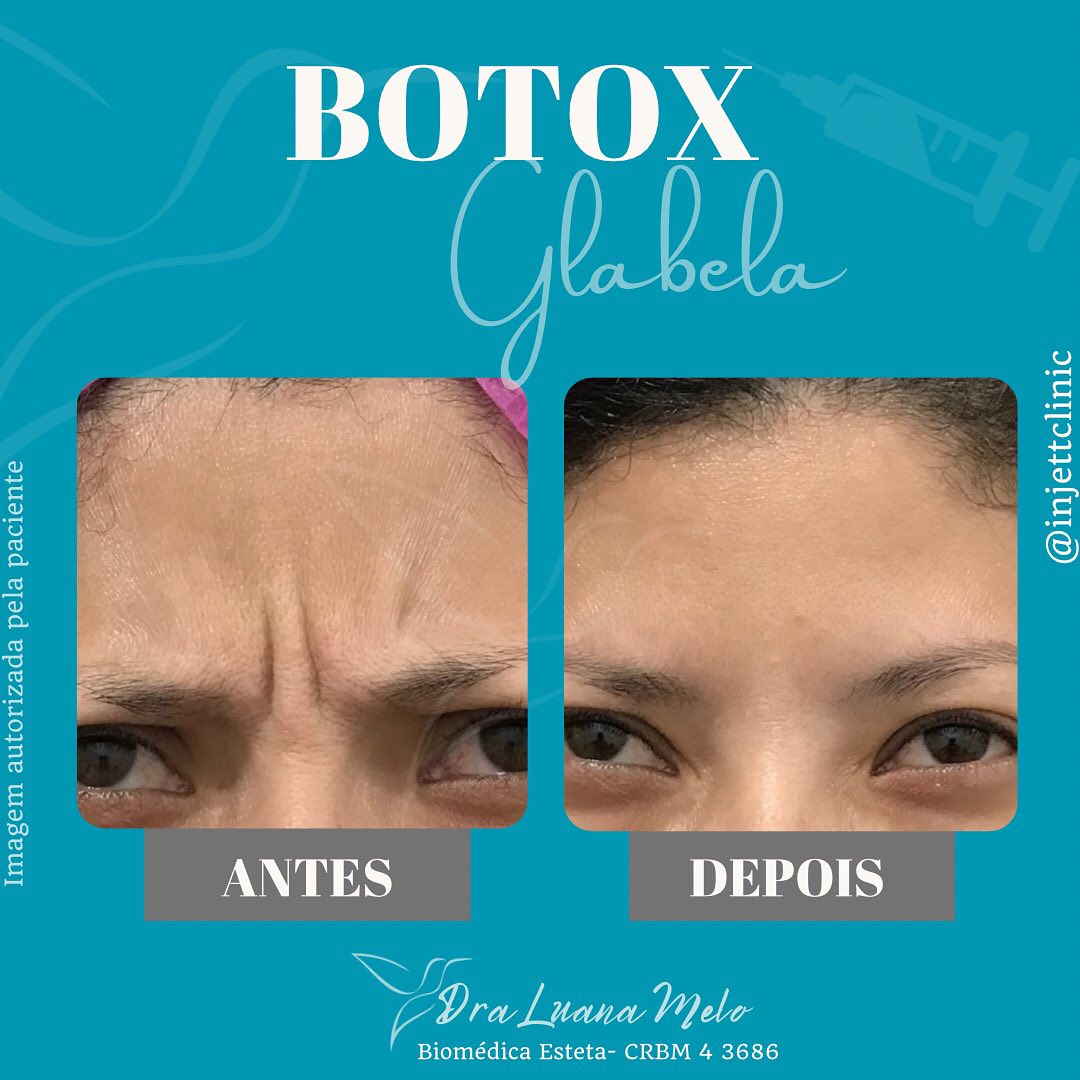 Botox glabela Toxina... - Injett Clinic • Estética Avançada