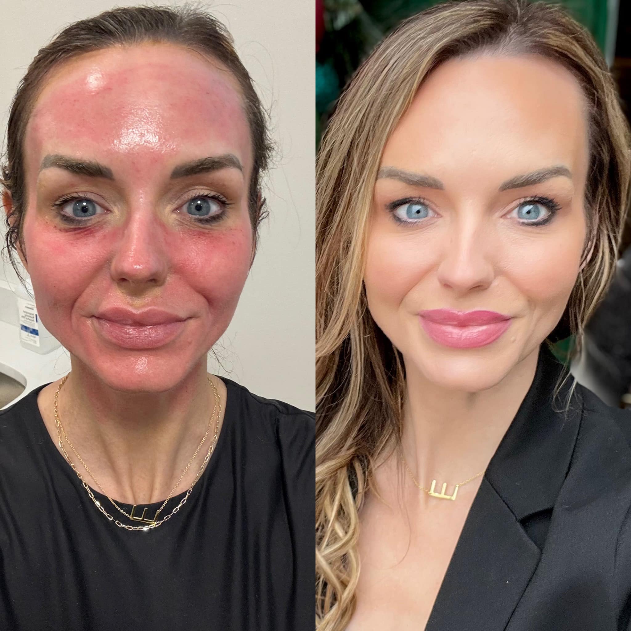 glutathione injection realself Our friend Dr. Alex Donath shares how to freshen up your face without going under the knife. #liquidluxe #holidaysparkle Cincinnati Facial Plastic Surgery Primary Sclerosing Cholangitis Stem Size:360 Softgels BPC-157 peptide therapy vial for tissue repair and recovery