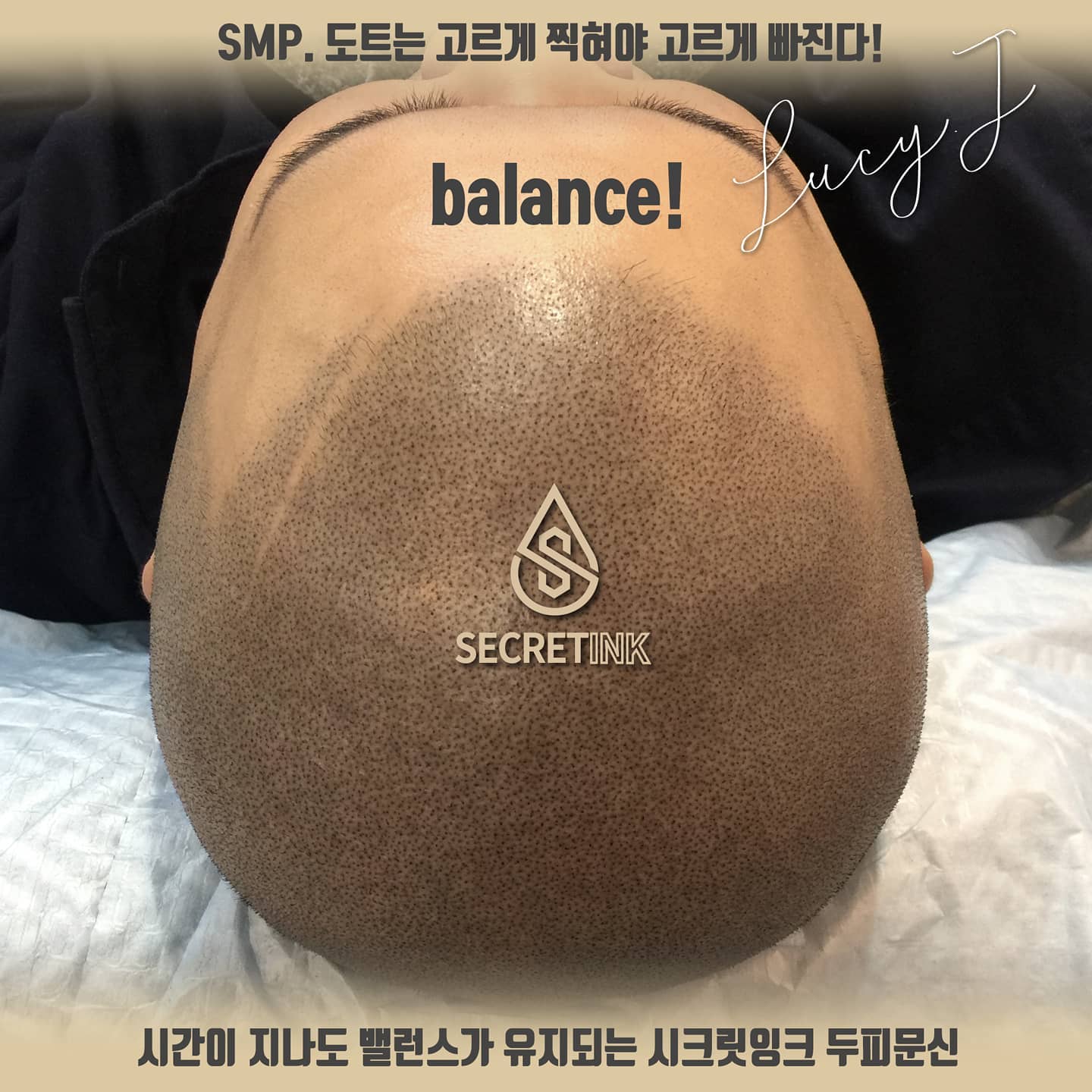 Secret ink - SMP 두피문신전용 영구색소를 사용하더라도 피부 속 색소는 시간이 지나면...