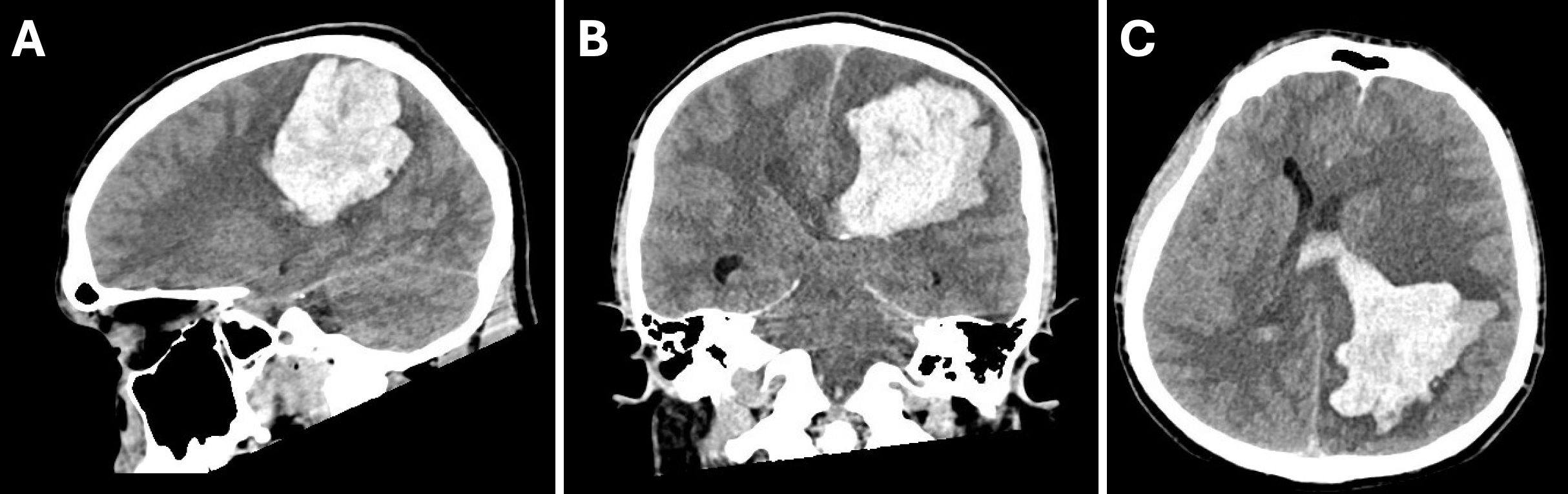 metastatic melanotic peripheral nerve sheath sarcoma covid He died at his home in Manhattan of Skulabs