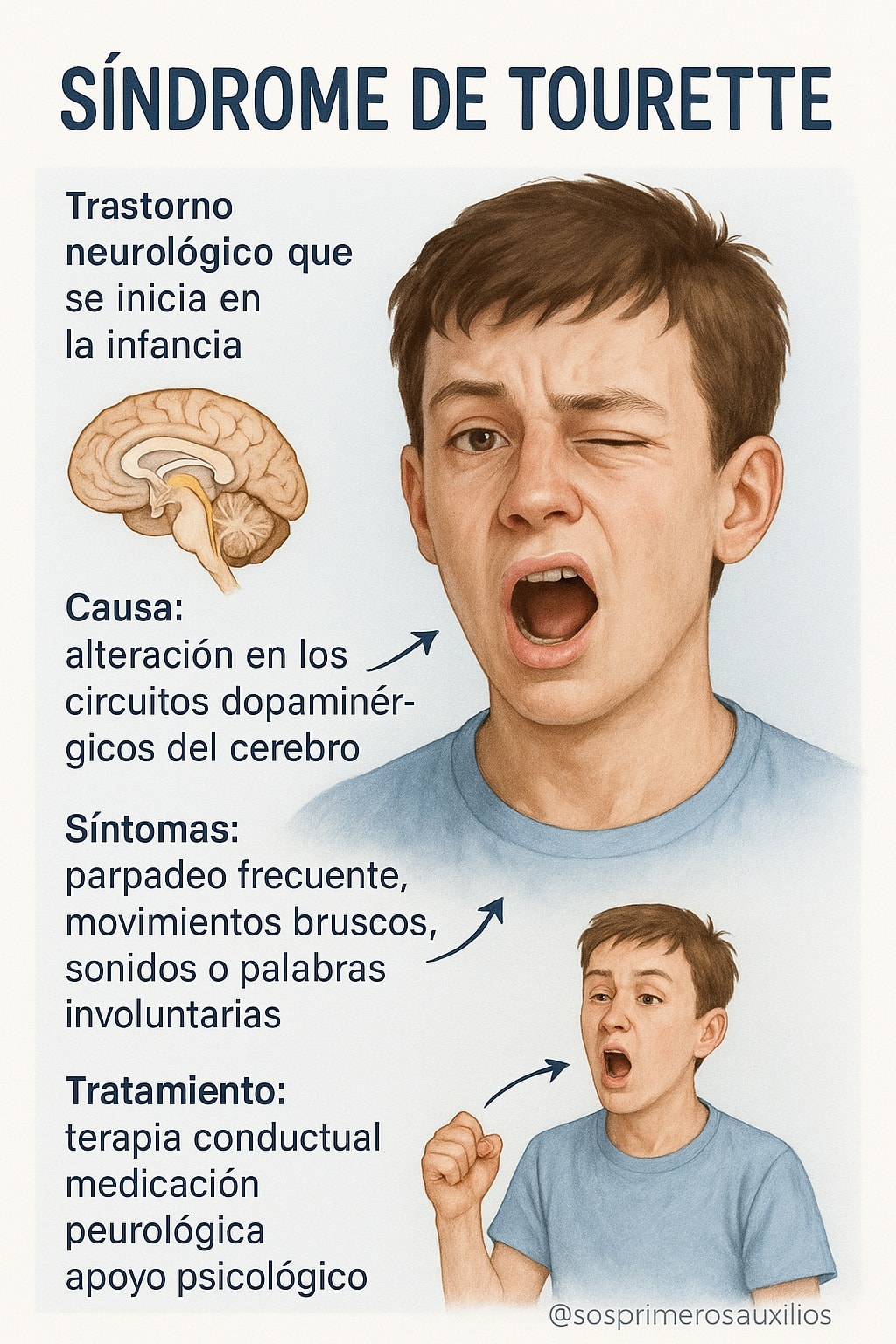 SOS - 🧠 Síndrome de Tourette: Mitos y Realidades El Síndrome de ...