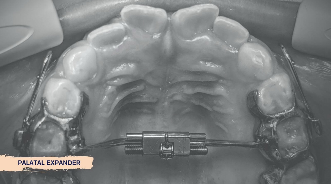 Dr. - 😬 What’s a Mouth Expander? A mouth expander (also called a ...