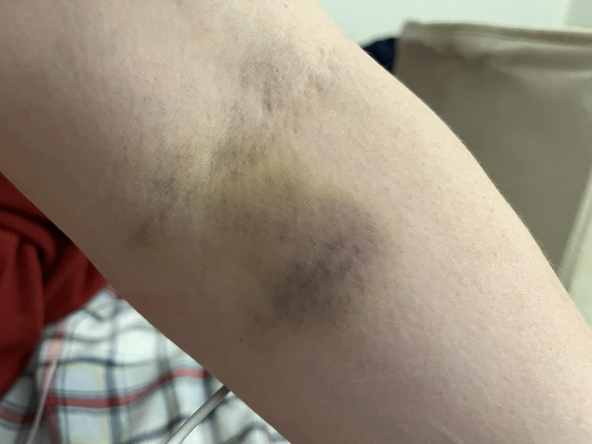 sore arm after vitamin b12 injection Does Hurt? Best Vitamin B12 Injection Sites: