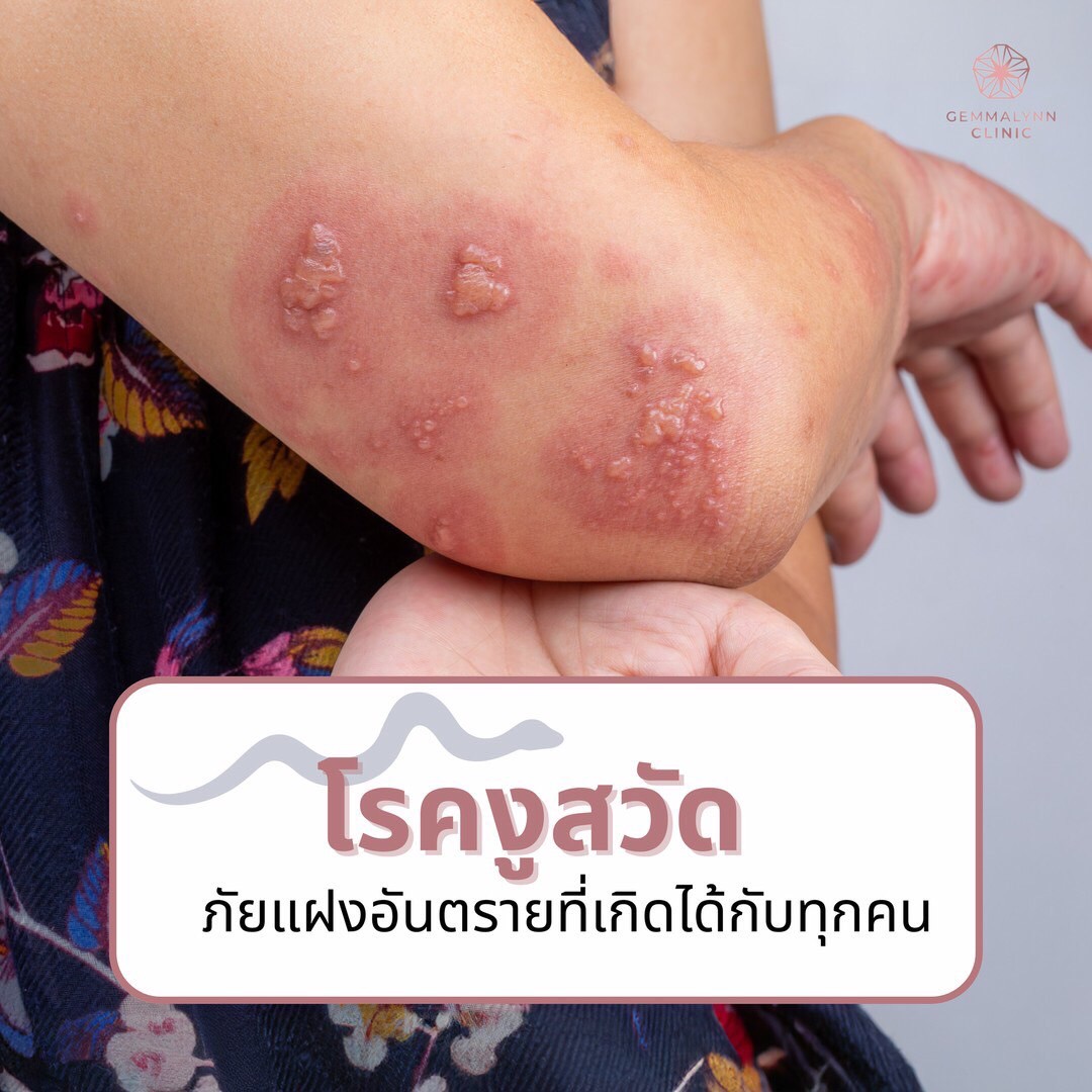Gemmalynn - โรคงูสวัด (Herpes Zoster) เป็นโรคผิวหนังชนิดหนึ่งที่เกิดจาก ...