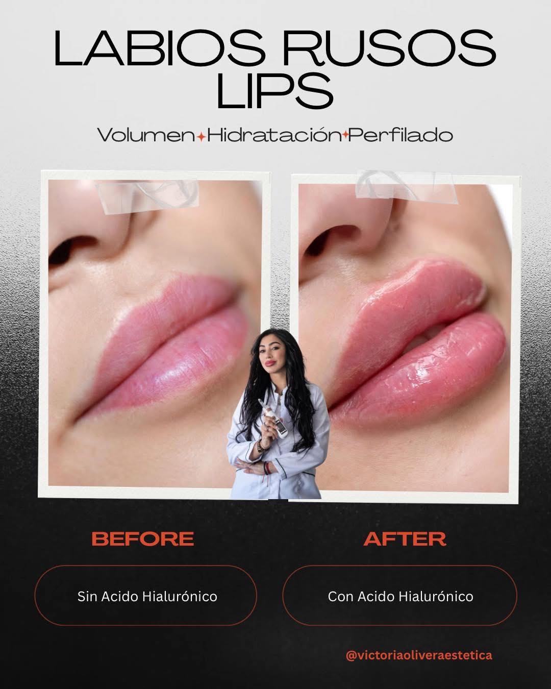 Ácido Hialurónico Aumento y Perfilado Labial, Botox Facial | Montevideo