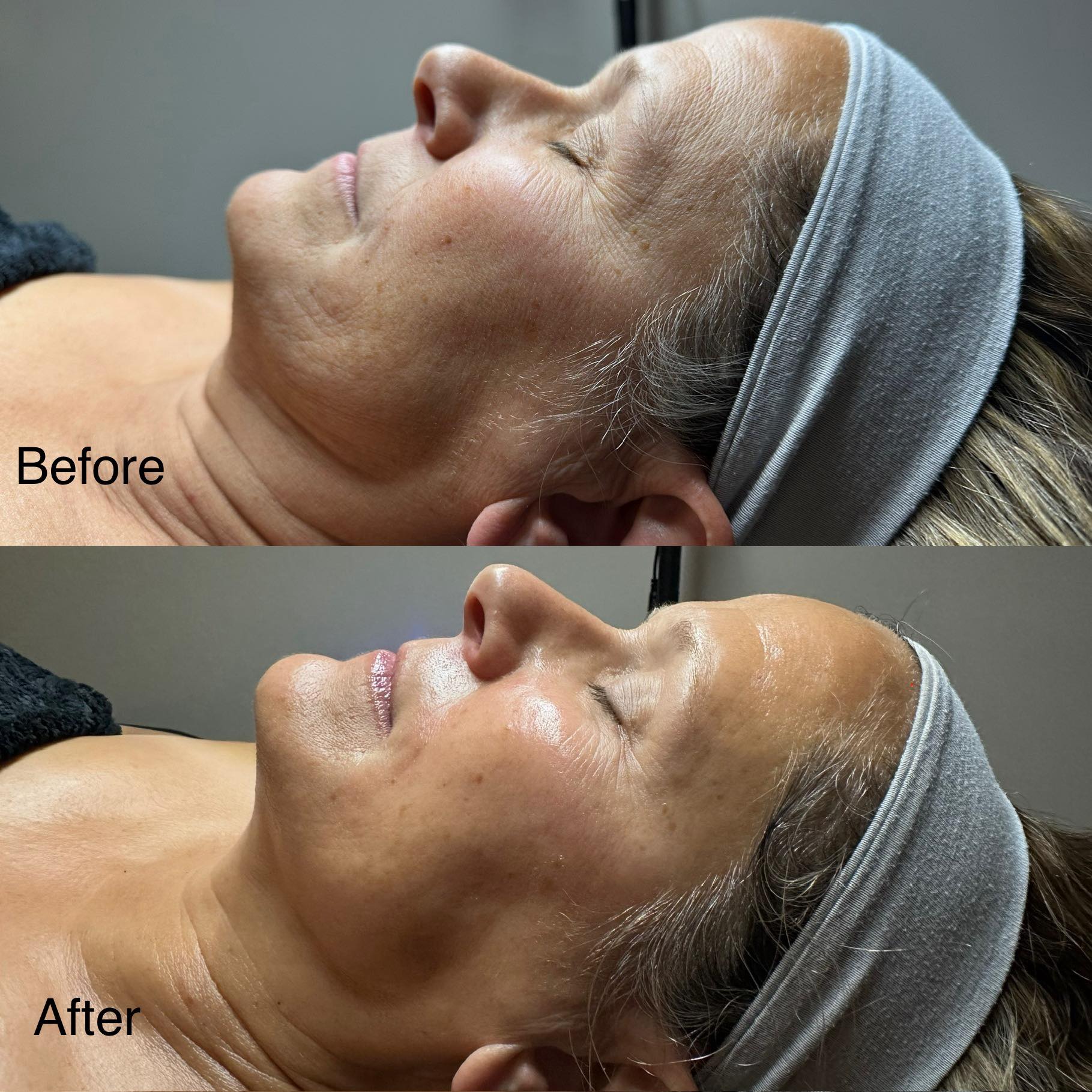 Skin - 💫KPS Resurfacing Peel Before + After Skin transformed ...