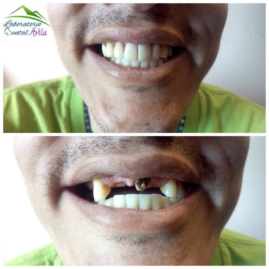 Laboratorio Dental Avila - Antes y después, colocación de prótesis ...