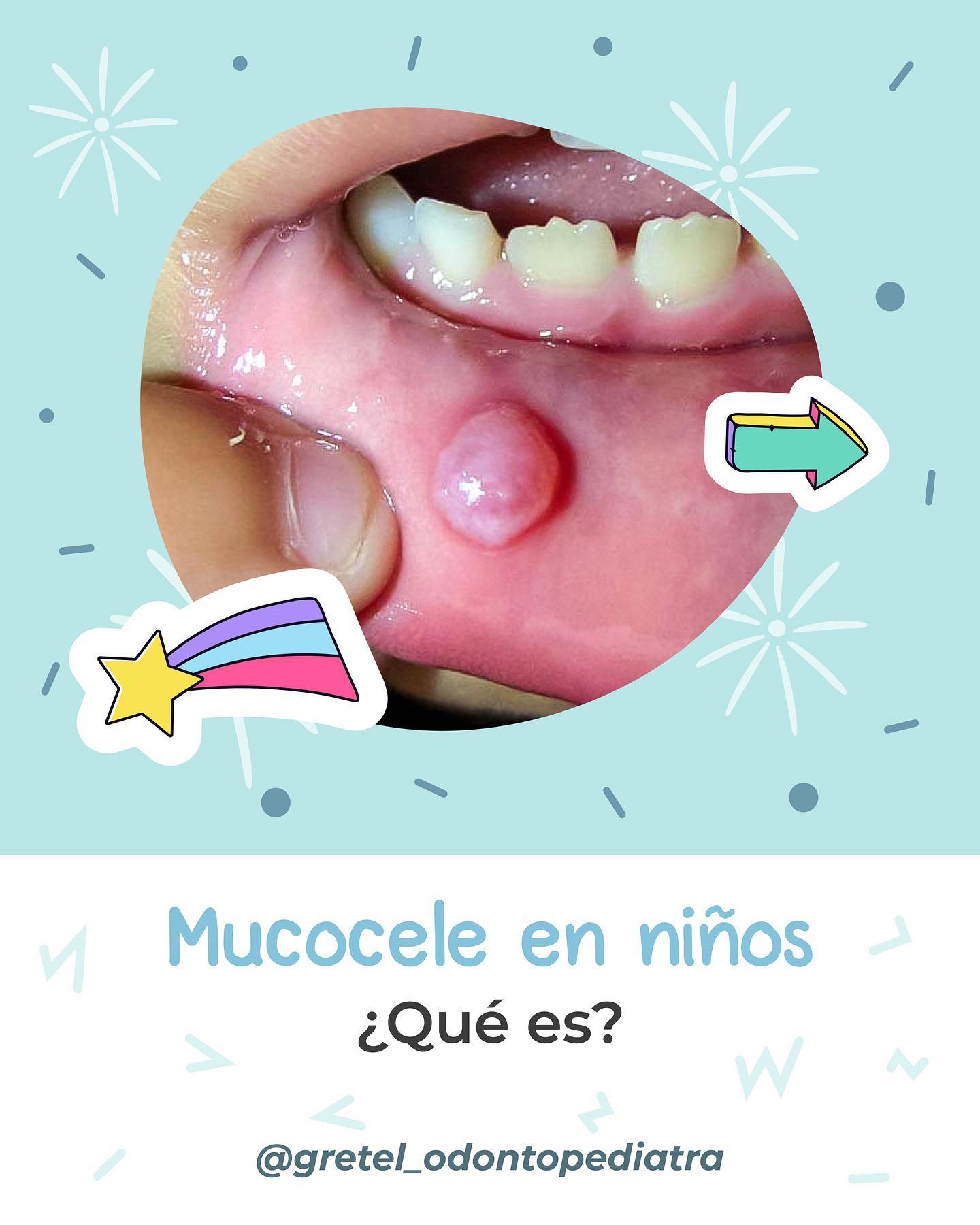 Los mucoceles son lesiones... - Odontopediatra Gretel Miracle | Facebook