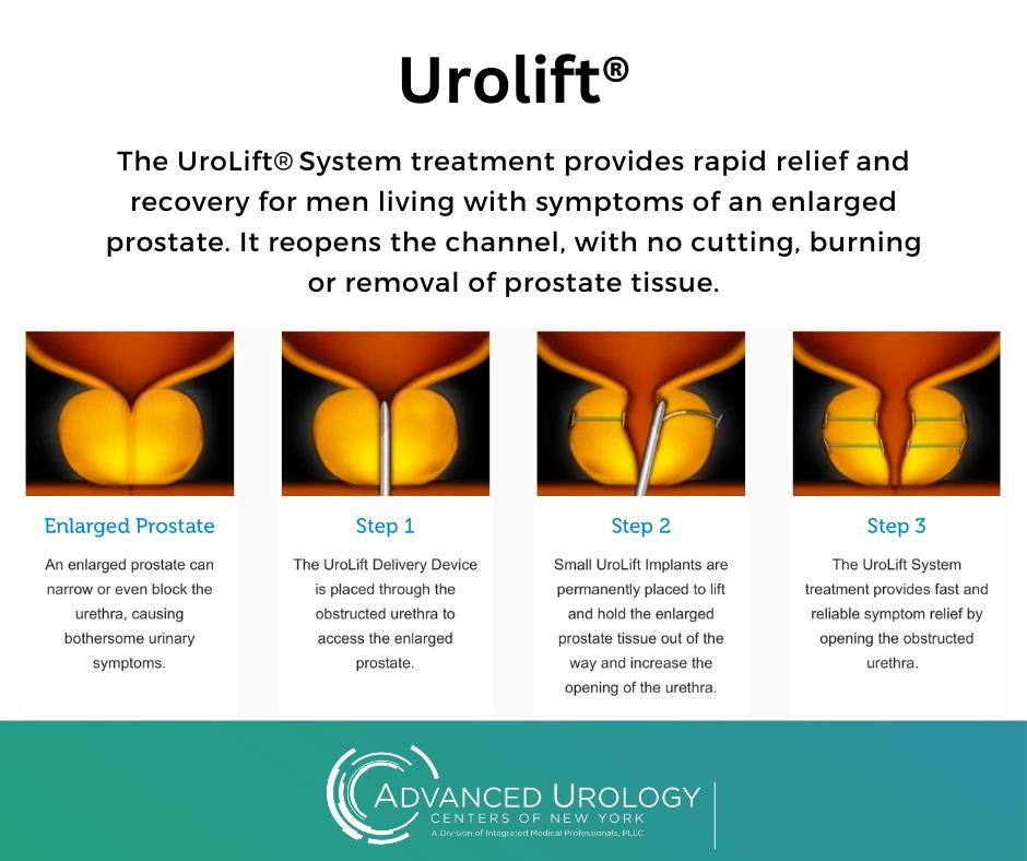 The UroLift® System... - Advanced Urology Centers Of New York | Facebook