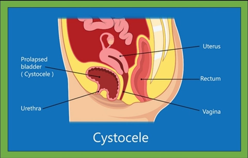 Anterior vaginal prolapse (#Cystocele) Anterior vaginal prolapse, also ...