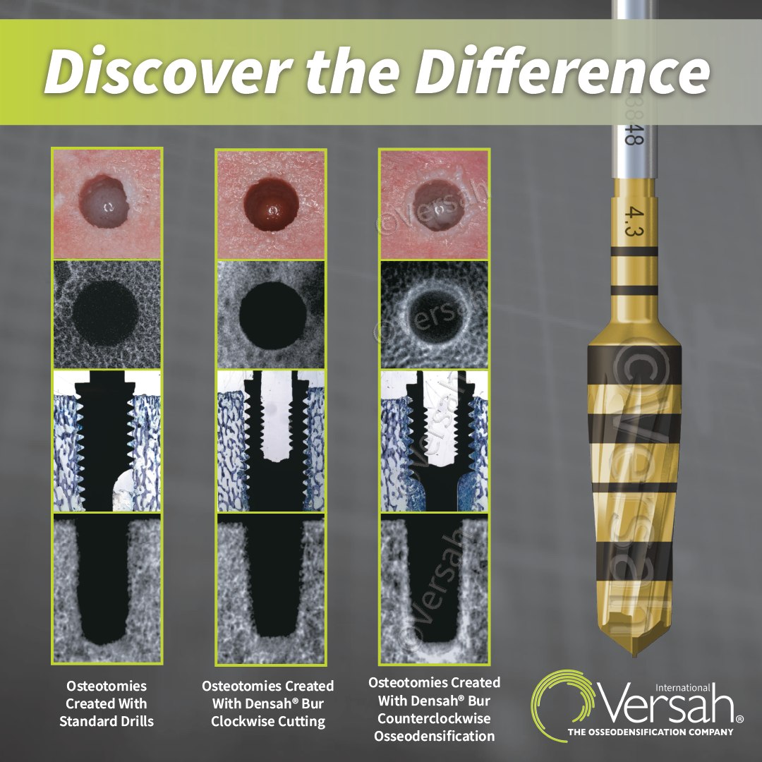 3a - Versah's Densah® Burs are specifically designed to autograft bone ...