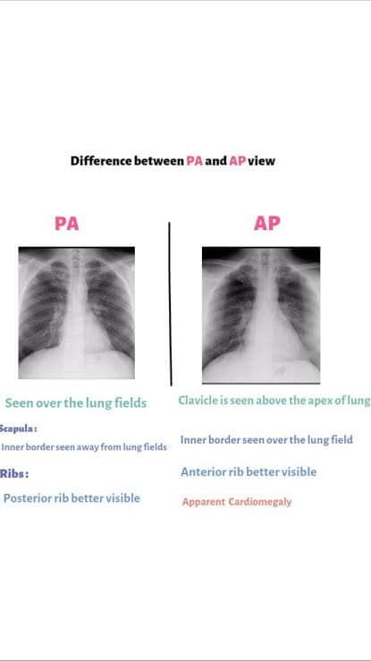 Medical - Chest X-ray AP/PA View & Abnormalities Chest... | Facebook