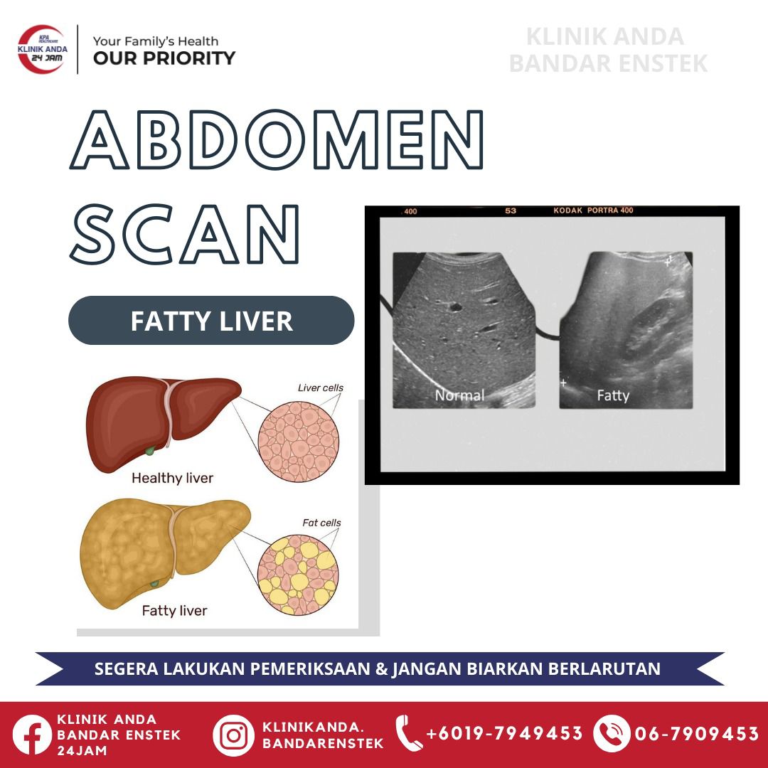 Klinik Anda - Abdomen Scan untuk mengesan hati berlemak (fatty liver) 🤔 ...