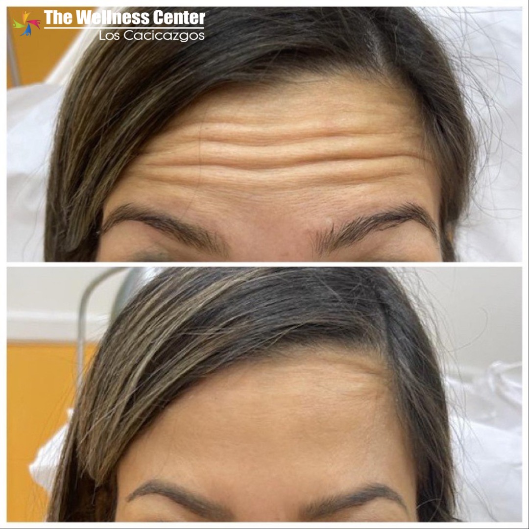 Full upper face Botox with... - The Wellness Center RD