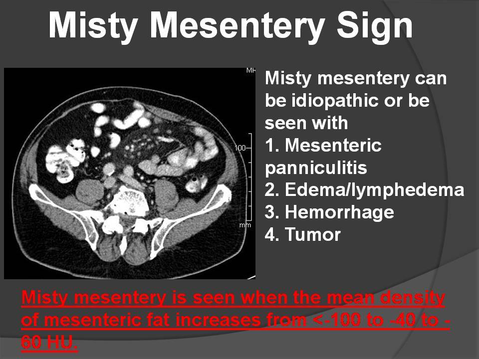 MISTY MESENTERY SIGN - Radiology Classroom
