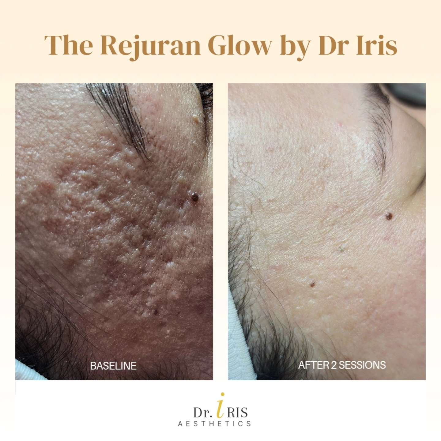 The Rejuran Glow by Dr. Iris ... - Dr. Iris Aesthetics | Facebook
