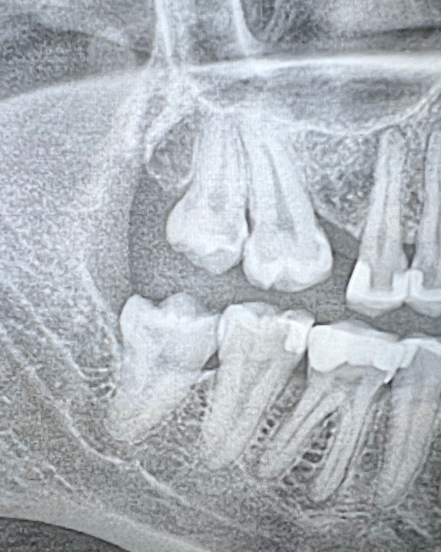 🦷 Wisdom Tooth Wednesday! 🦷... - LaGrange Family Dentistry