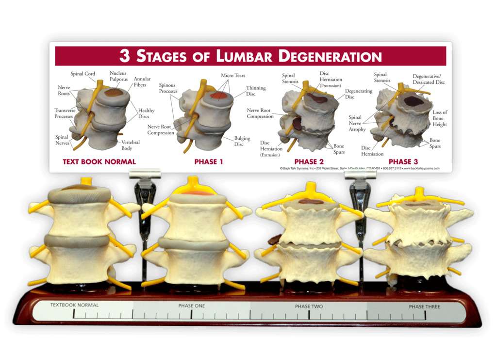 TLC - WHAT PHASE ARE YOU IN? The 3 Phases of Spinal Degeneration ...