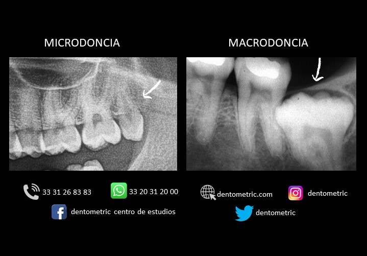 Las anomalías dentarias... - Dentometric Centro de Estudios