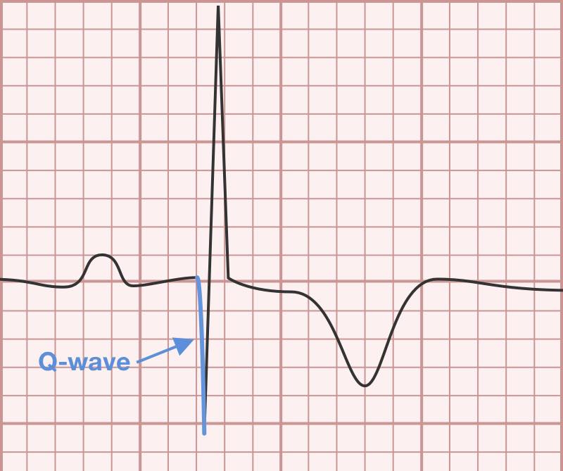 💓 Dagger Q Waves & Hypertrophic... - Medicine for all | Facebook