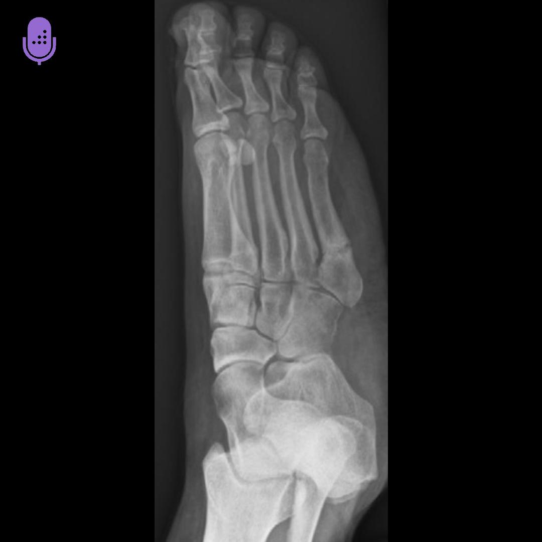 Orthobullets - 5th Metatarsal Base Fractures are among the... | Facebook