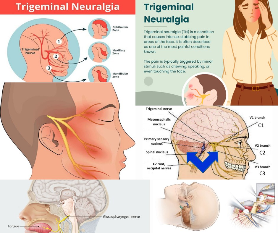 b12 injections for trigeminal neuralgia Vitamin and Alpha Lipoic Acid Neuropathy b12 injections for trigeminal neuralgia