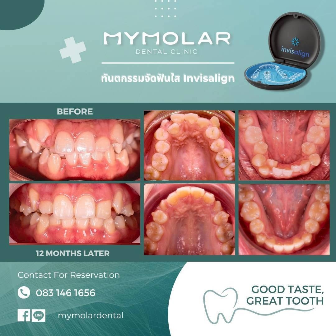 MyMolar - Case review 💯📸 จัดฟันใส Invisalign แบบซับซ้อนเพื่อแก้ไขฟัน ...