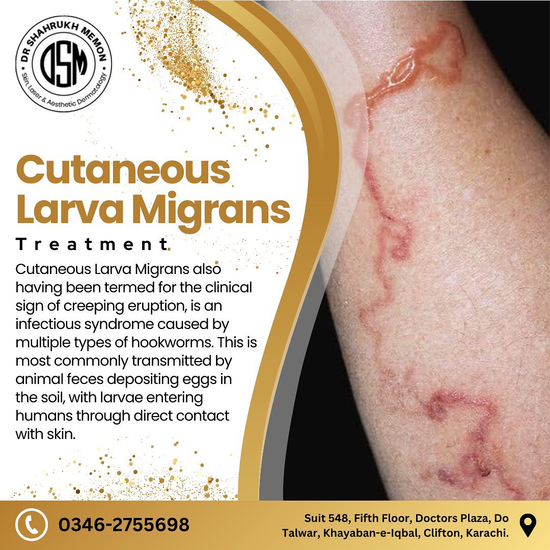Cutaneous Larva Migrans