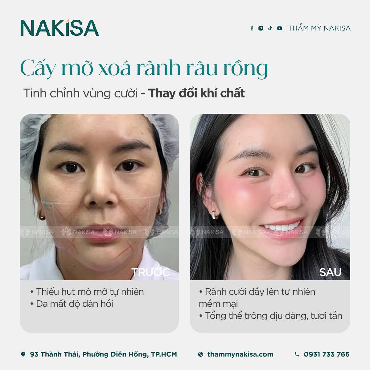 Thẩm - 🌿 CẤY MỠ XÓA RÃNH RÂU RỒNG Tinh chỉnh vùng cười – Thay đổi khí ...