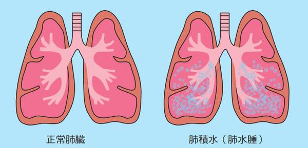 余騰瑋犬貓心臟專科醫師 心臟病為什麼會引發肺積水 心衰竭為什麼造成肺部積水呢 Facebook