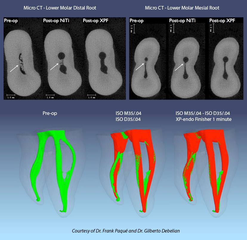 Fkg Dentaire Sa Xp Endo Finisher 4 13 Clinical Case Dr Gilberto Debelian And Dr Frank Paque Micro Ct Of The Distal And Mesial Roots Of A Lower Molar Instrumented To 35 04