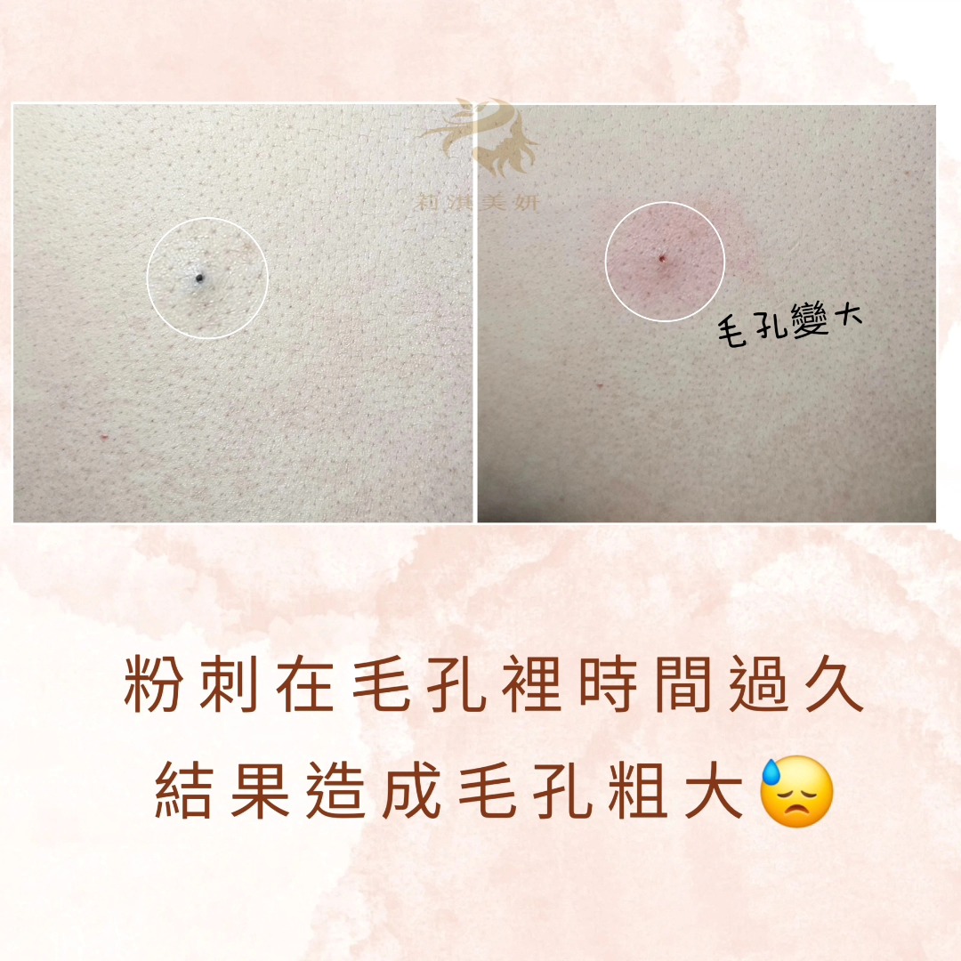 莉淇美妍 - 深層黑頭粉刺與一般的粉刺有所不同，黑頭粉刺在沒有清的狀況下 ,皮脂會逐漸的堆積 ,粉刺就會越來越大,毛孔因被大粉刺給撐大,所以 ...
