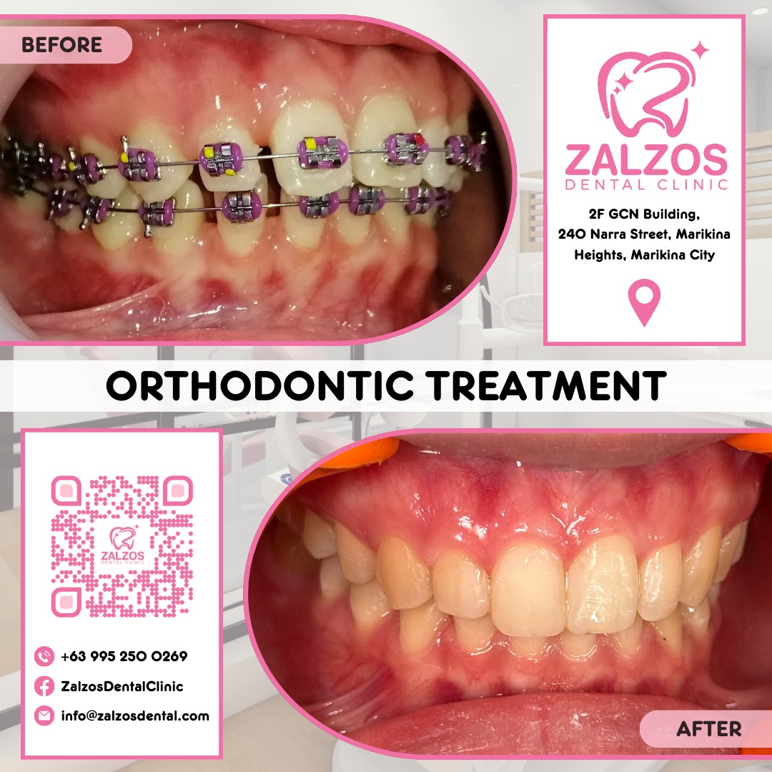 🌟 Transforming Smiles: Before &... - Zalzos Dental Clinic | Facebook