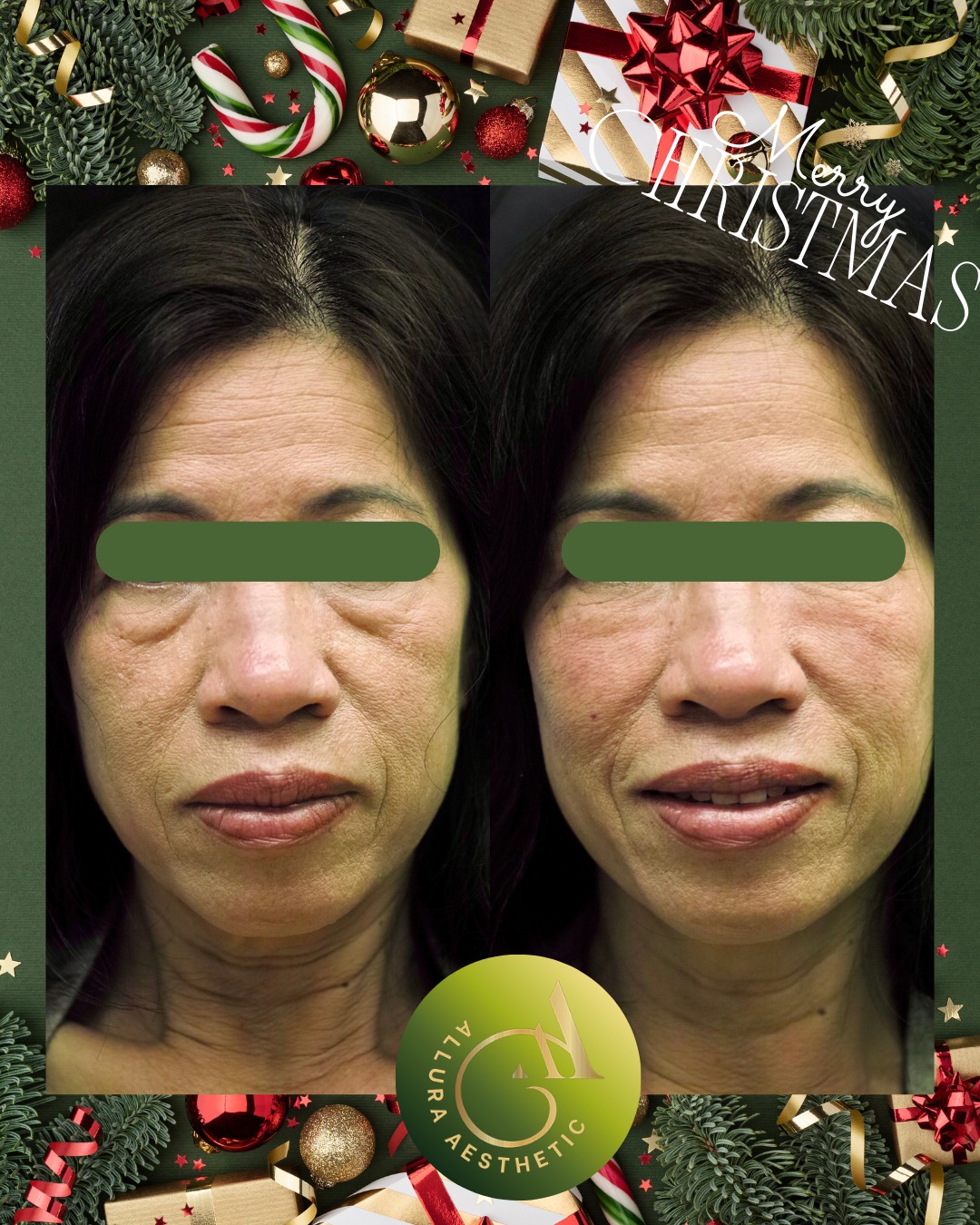 Alluraesthetic - 𝐓𝐢𝐫𝐞𝐝, 𝐡𝐨𝐥𝐥𝐨𝐰 𝐮𝐧𝐝𝐞𝐫-𝐞𝐲𝐞𝐬 𝐝𝐨𝐧’𝐭 𝐬𝐭𝐚𝐧𝐝 𝐚 𝐜𝐡𝐚𝐧𝐜𝐞. Our ...