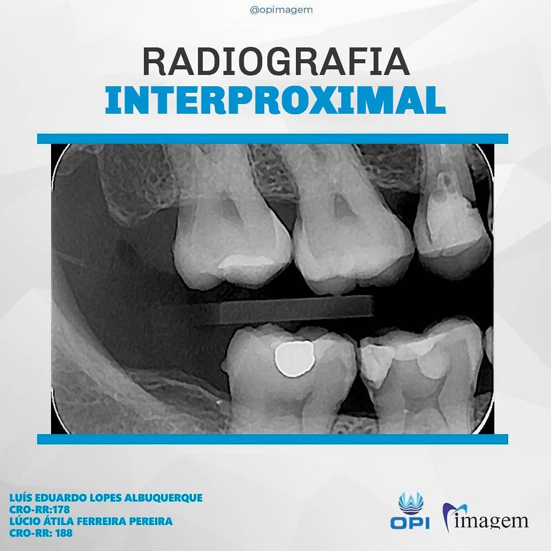 A radiografia interproximal é uma... - Odontologiaporimagem