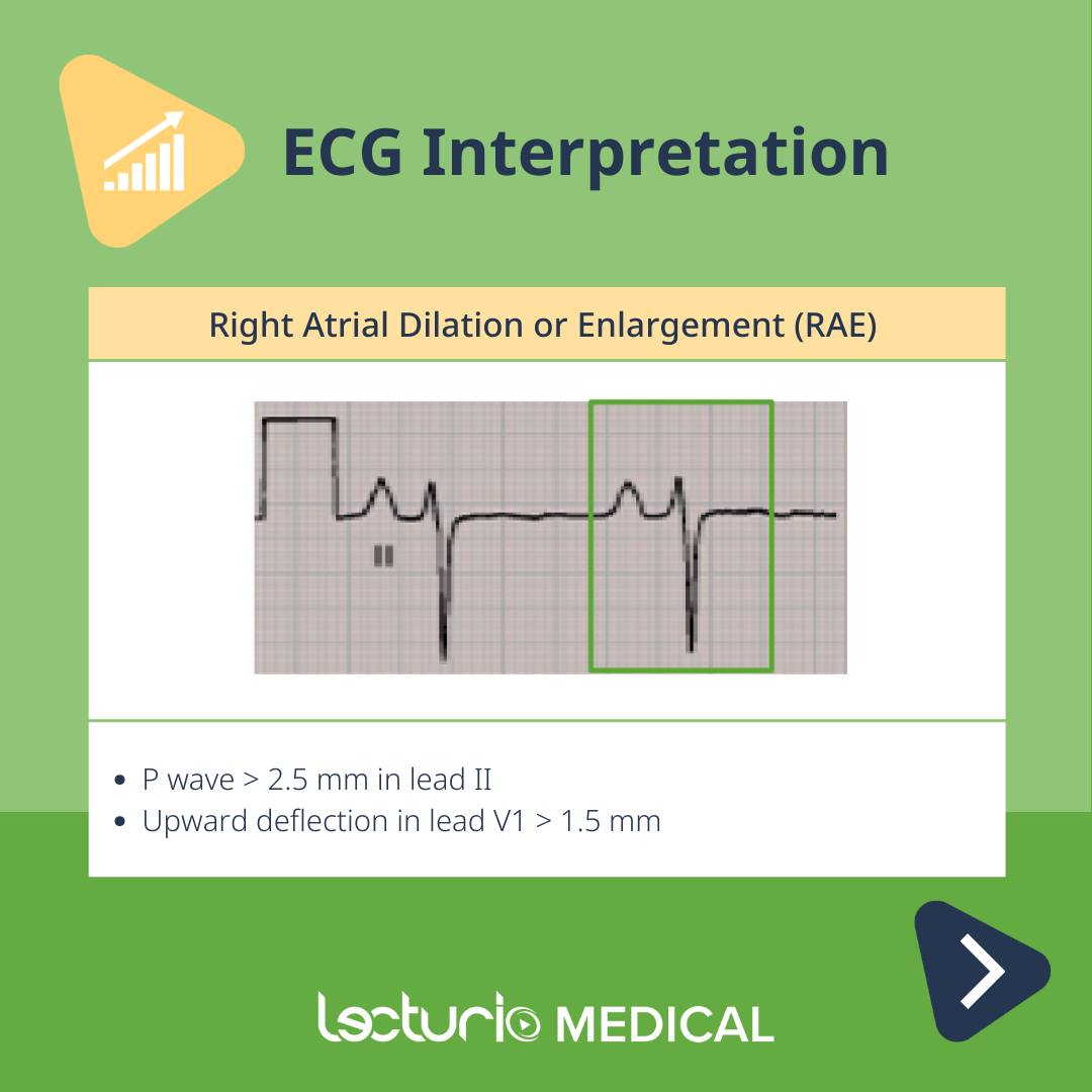 🩺 Understanding Atrial Enlargement... - Lecturio Medical | Facebook