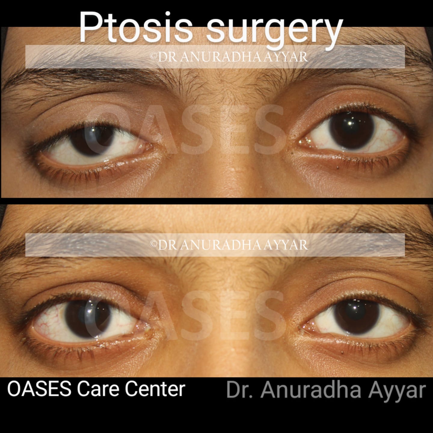 Droopy eyelid correction in an 18 year... - OASES Care Center